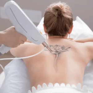 Remoção de tatuagens